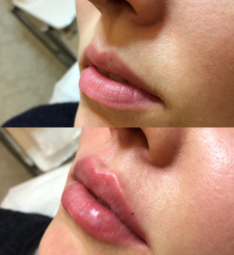 губы накаченные фото до и после красивые